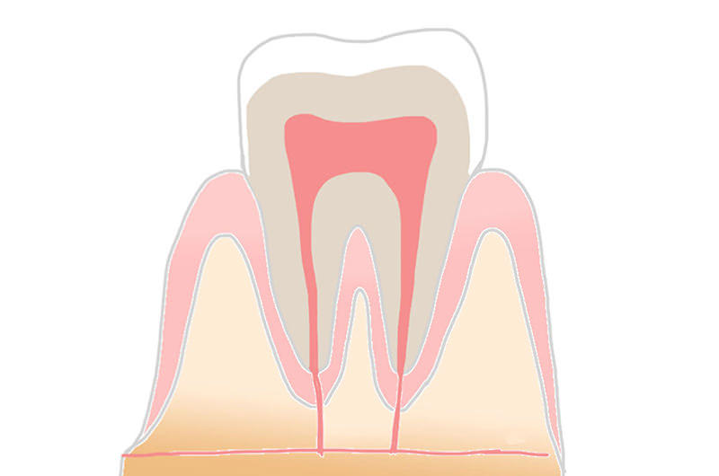 C0：進行度1段階目の虫歯