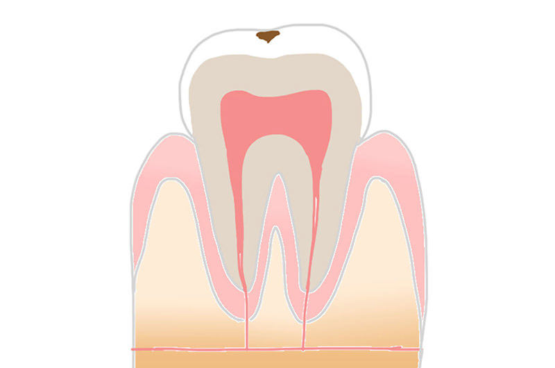 C1：進行度2段階目の虫歯