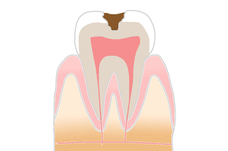 C2：進行度3段階目の虫歯