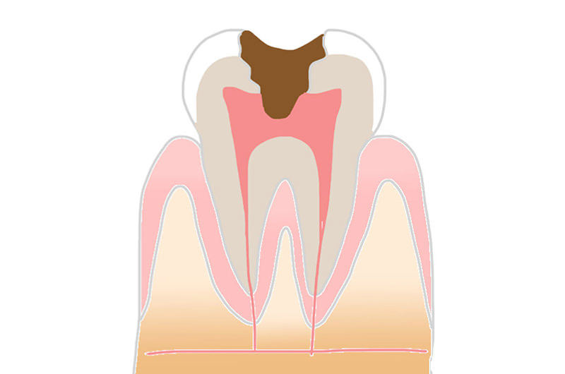 C3：進行度4段階目の虫歯