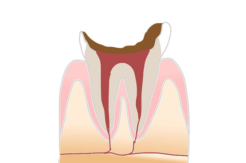 C4：進行度5段階目の虫歯